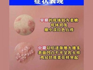 女性尿道口摸起来有点小疙瘩，可能是感染了尖锐湿疣